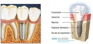 Implant vs dent
